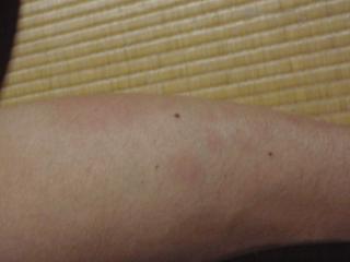 アナフィラキシーショック治療後の腕の写真